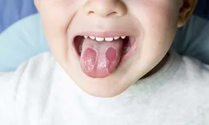 Bệnh lưỡi bản đồ Bệnh lưỡi bản đồ