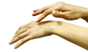 Mất vân tay do chàm có chữa được không? Mất vân tay do chàm có chữa được không?