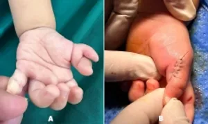 Trẻ dị tật thừa ngón nên phẫu thuật trước một tuổi Trẻ dị tật thừa ngón nên phẫu thuật trước một tuổi