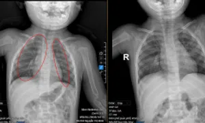 Bé trai hai lần viêm phổi trong một tuần Bé trai hai lần viêm phổi trong một tuần