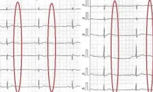 Ngất xỉu do bị block nhĩ thất